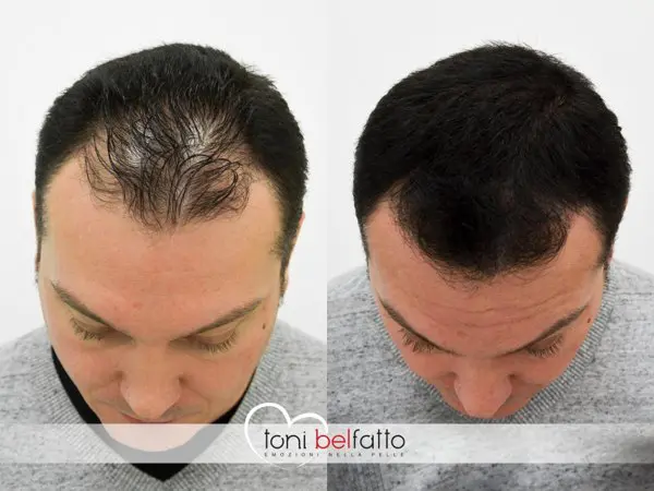 Tricopigmentation - Bases